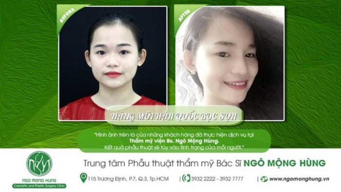 Nâng mũi bọc sụn