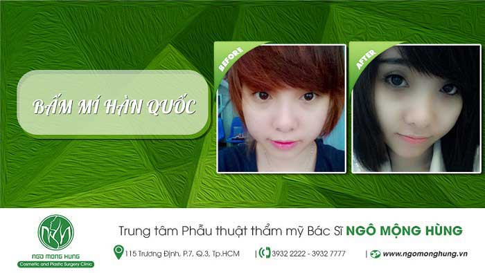Bấm mí Hàn Quốc