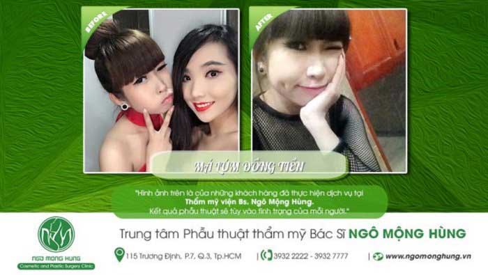 Má lúm đồng tiền