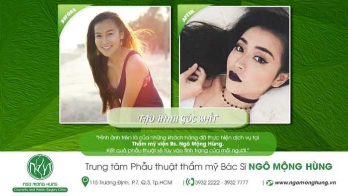 Mở rộng góc mắt Mở rộng góc mắt