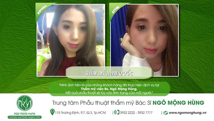 Bấm mí Hàn Quốc