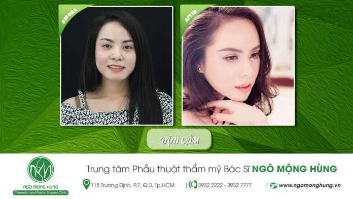 Độn cằm