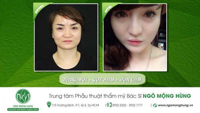 Độn cằm
