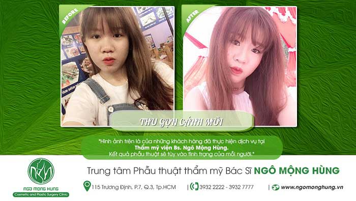 Thu gọn cánh mũi