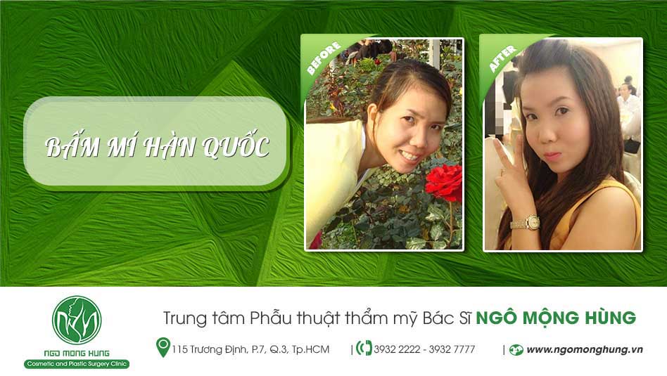 Bấm mí Hàn Quốc