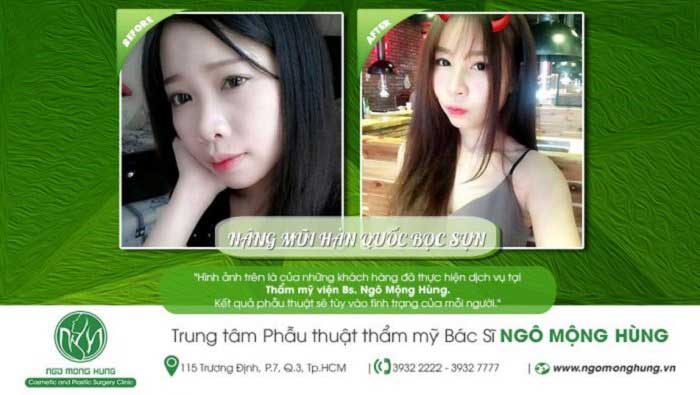 Nâng mũi bọc sụn