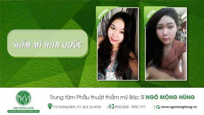 Bấm mí Hàn Quốc