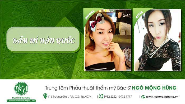 Bấm mí Hàn Quốc