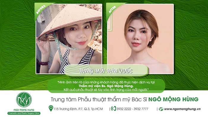 Nâng mũi Hàn Quốc