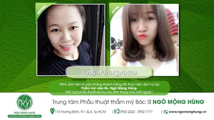 Nâng mũi bọc sụn