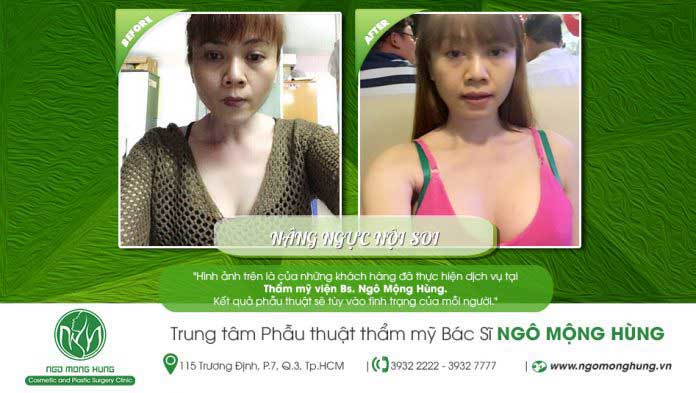 Nâng ngực nội soi