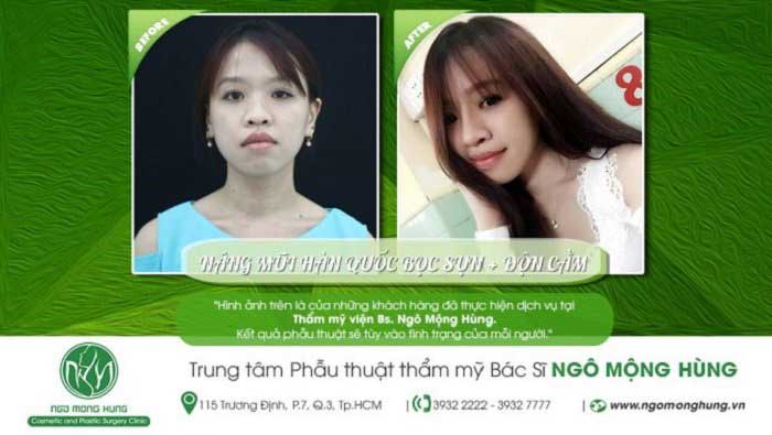 Nâng mũi bọc sụn