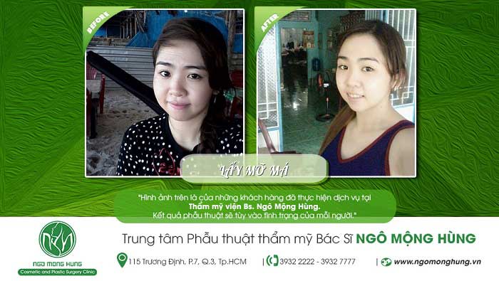 Lấy mỡ má