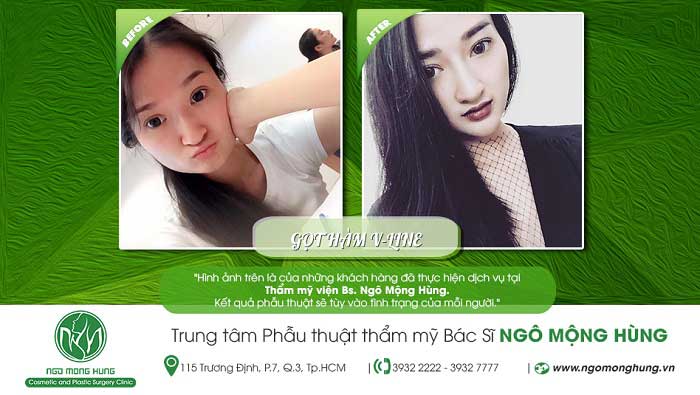 Gọt cằm