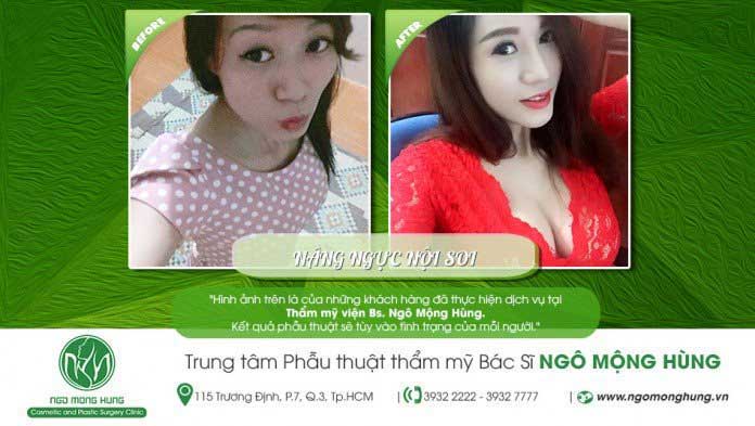 Nâng ngực nội soi