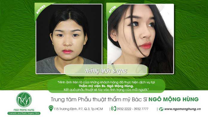 Nâng mũi S Line