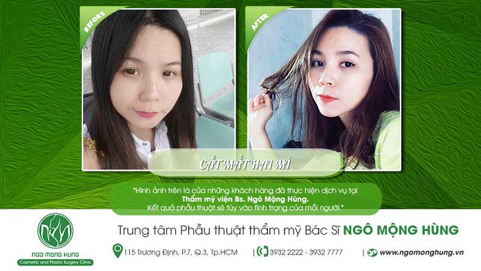Cắt mí mắt