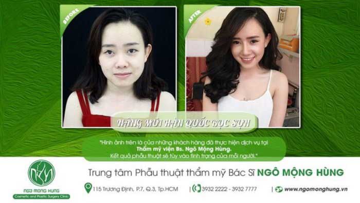 Nâng mũi bọc sụn