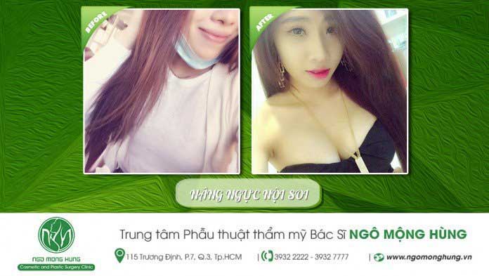 Nâng ngực nội soi