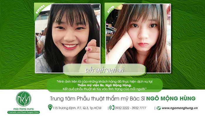 Cắt mí mắt