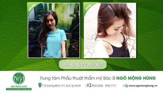 Nâng ngực nội soi