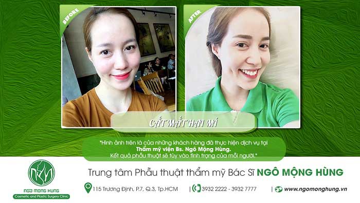 Cắt mí mắt