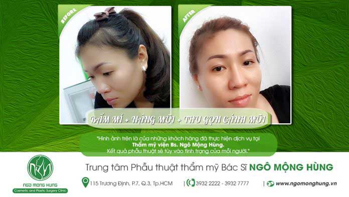 Bấm mí Hàn Quốc Bấm mí Hàn Quốc