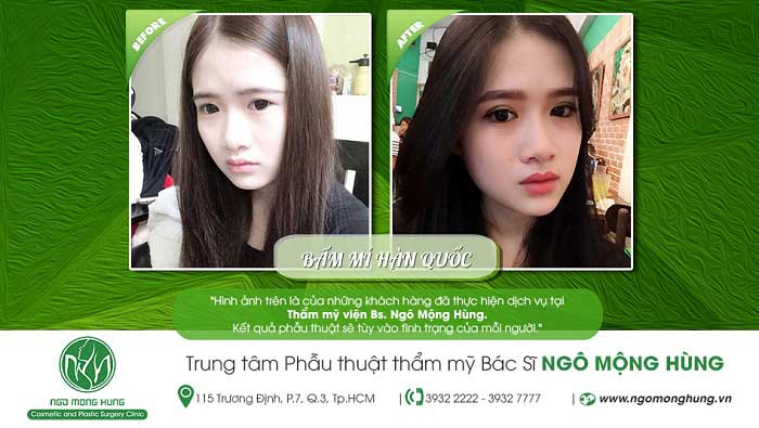 Bấm mí Hàn Quốc