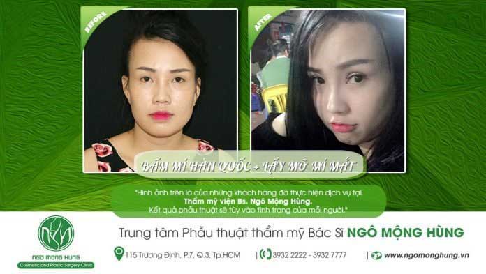 Bấm mí Hàn Quốc