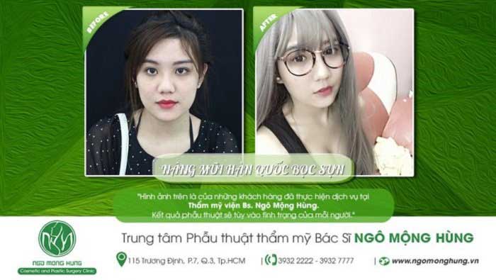 Nâng mũi bọc sụn