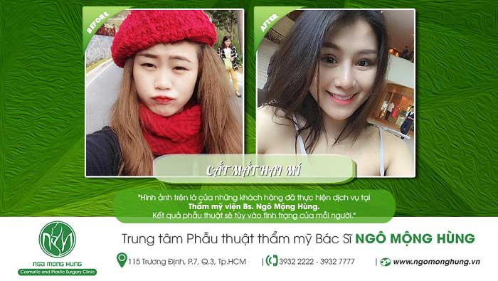 Cắt mí mắt