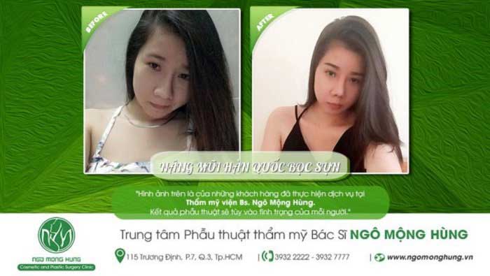 Nâng mũi bọc sụn