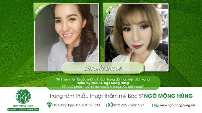 Cắt mí mắt