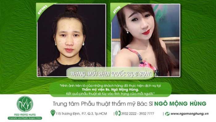 Nâng mũi bọc sụn