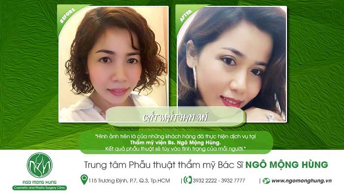 Cắt mí mắt