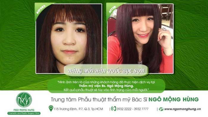 Nâng mũi bọc sụn