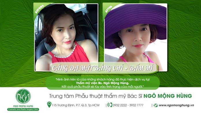 Căng da mặt Căng da mặt