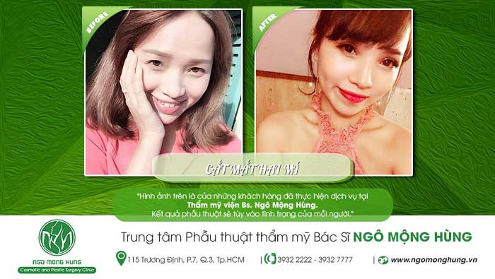 Cắt mí mắt