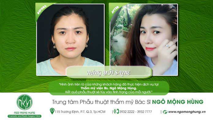 Nâng mũi  S Line