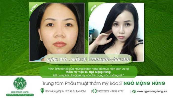 Nâng mũi Hàn Quốc