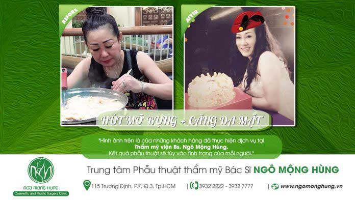 Căng da mặt