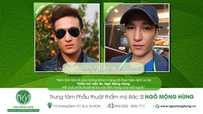 Làm đầy môi