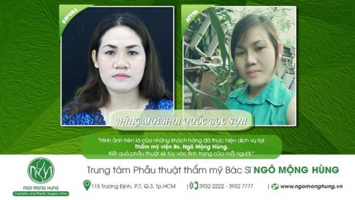 Nâng mũi bọc sụn