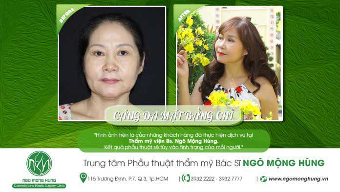 Căng da mặt