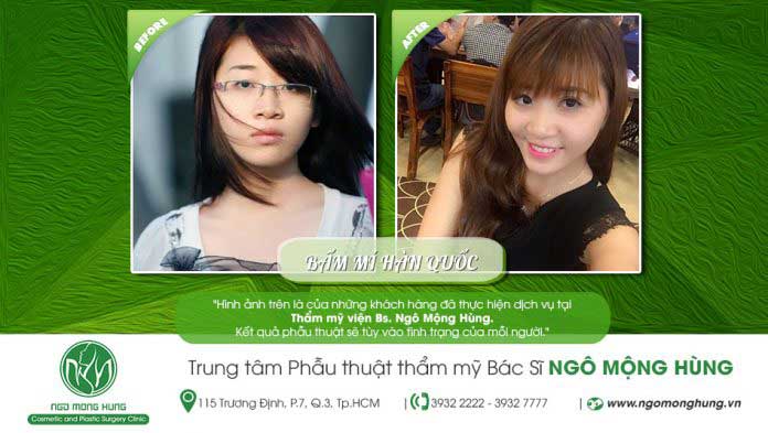 Bấm mí Hàn Quốc