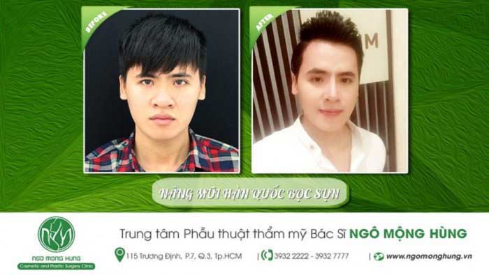 Nâng mũi bọc sụn