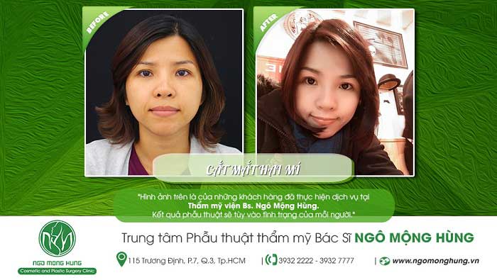 Cắt mí mắt