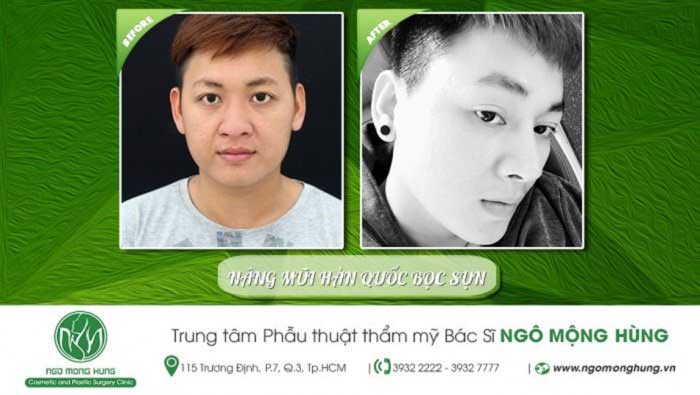 Nâng mũi bọc sụn