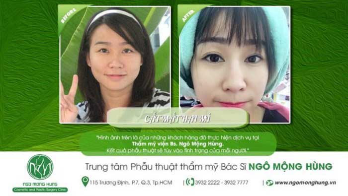 Cắt mí mắt