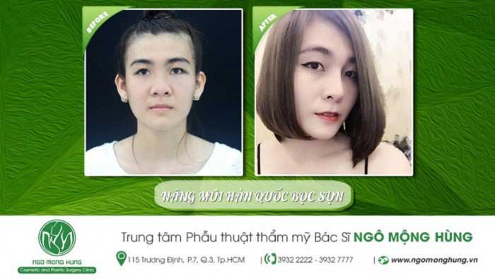 Nâng mũi Hàn Quốc
